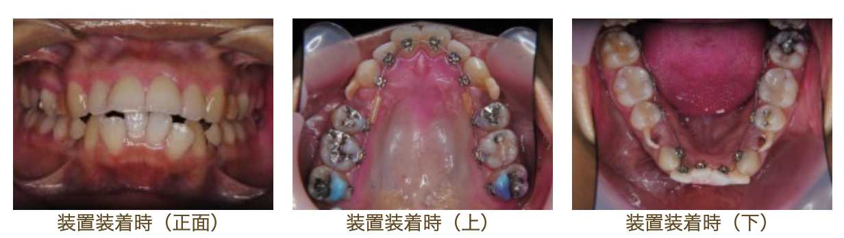 リンガルブラケット⑳　口元を引っ込めたい方