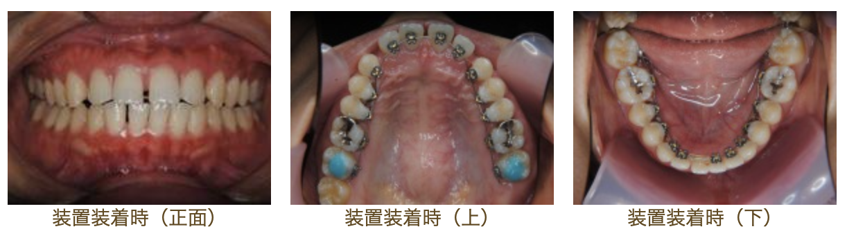 リンガルブラケット⑲　口元を引っ込めたい方