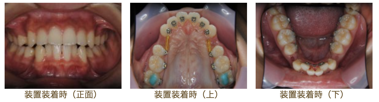 リンガルブラケット⑱　口元を引っ込めたい方