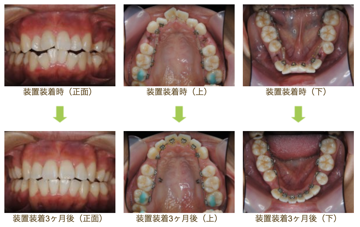 リンガルブラケット⑰　口元を引っ込めたい方