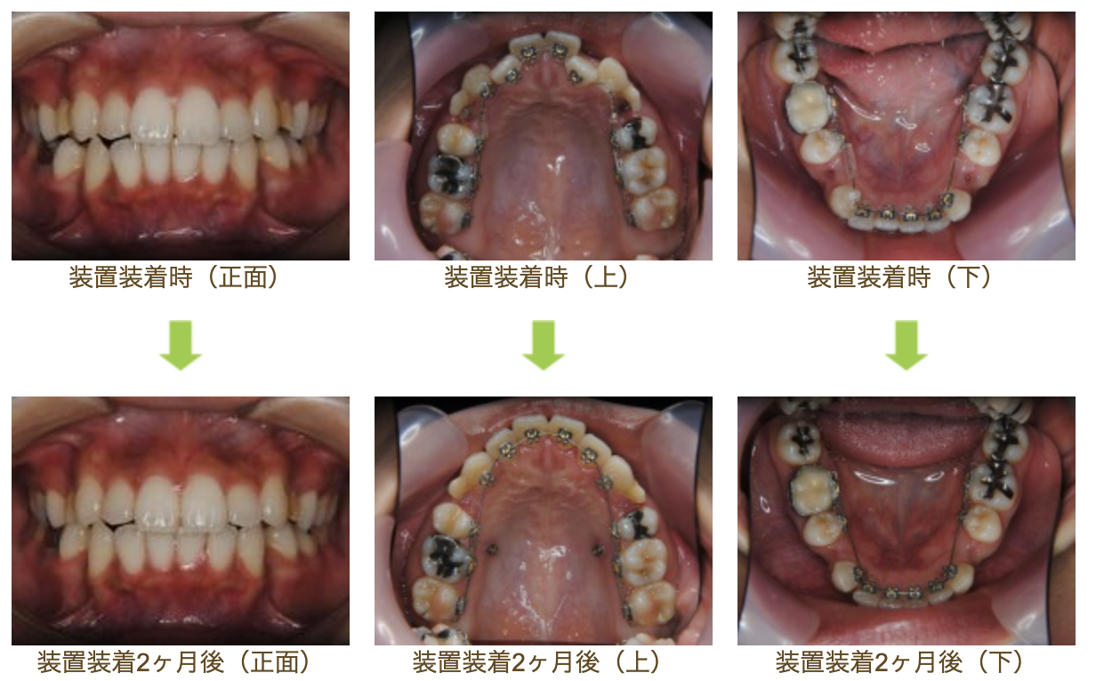 リンガルブラケット⑯　口元を引っ込めたい方