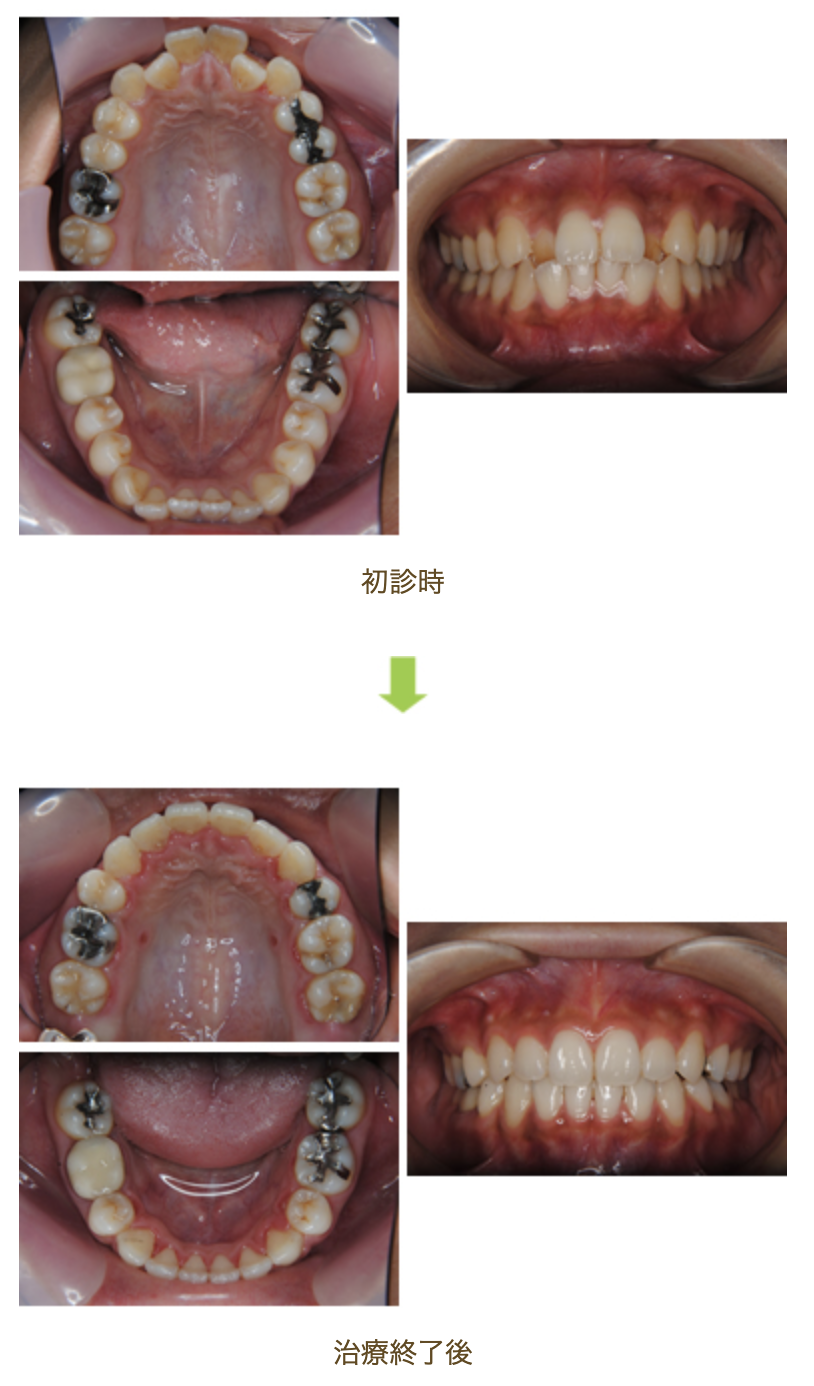 リンガルブラケット⑯　口元を引っ込めたい方