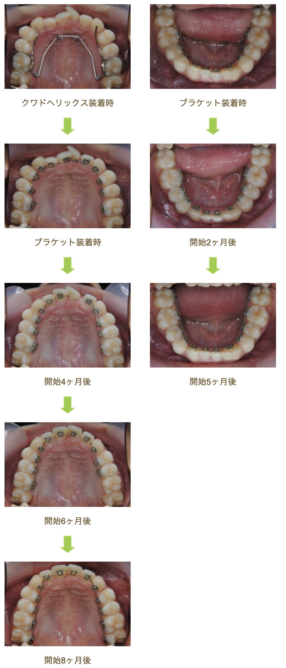 リンガルブラケット⑮　デコボコを治したい方