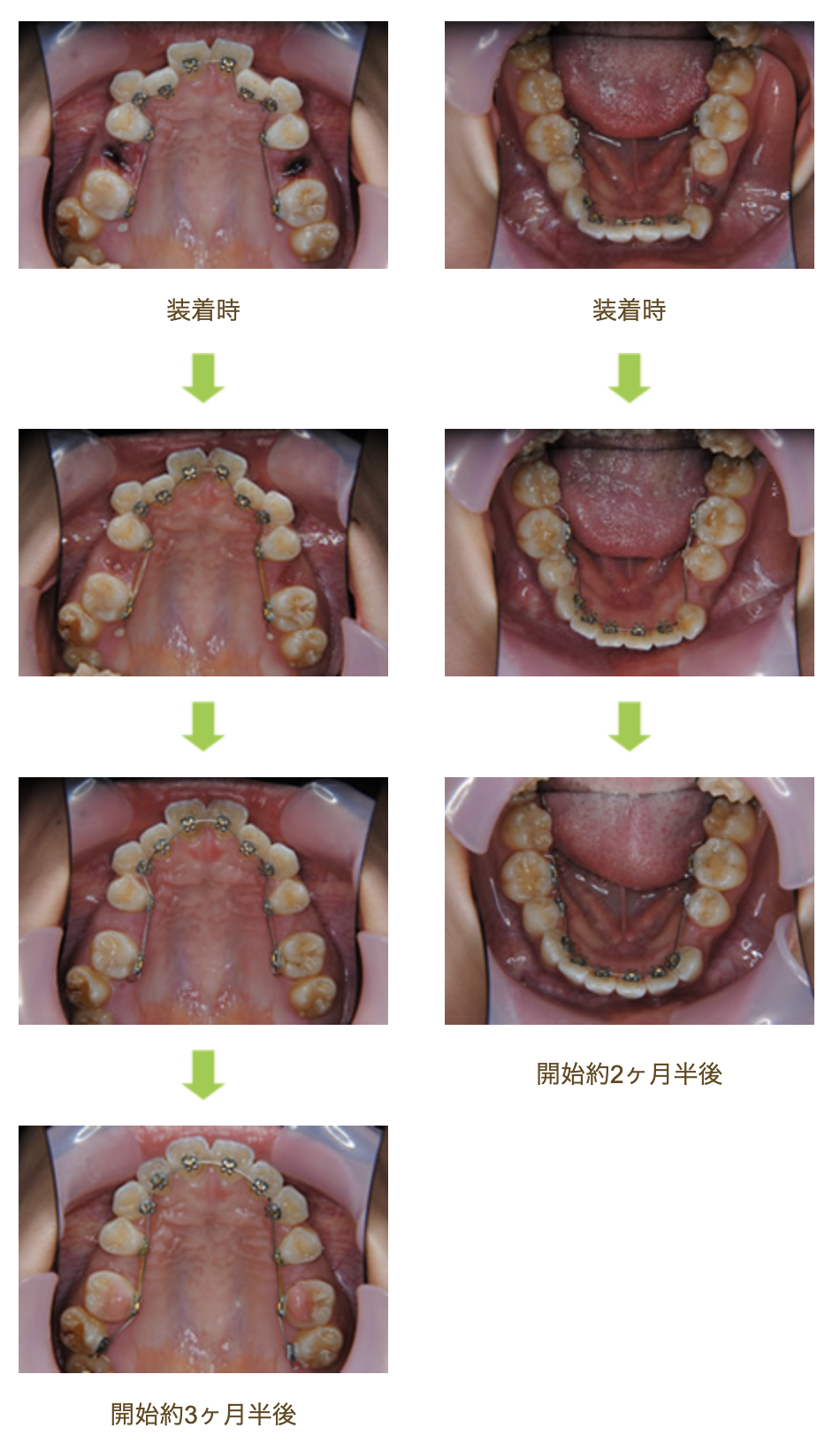 リンガルブラケット⑭　デコボコを治したい 受け口を治したい方