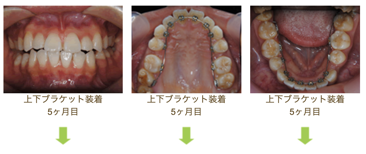 リンガルブラケット⑭　デコボコを治したい 受け口を治したい方