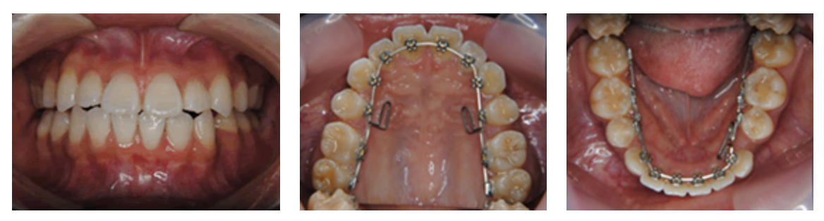 リンガルブラケット⑭　デコボコを治したい 受け口を治したい方