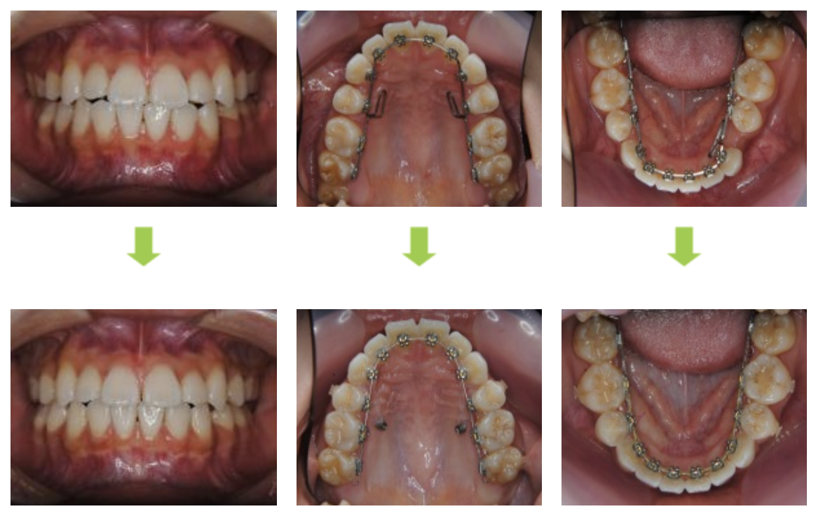 リンガルブラケット⑭　デコボコを治したい 受け口を治したい方