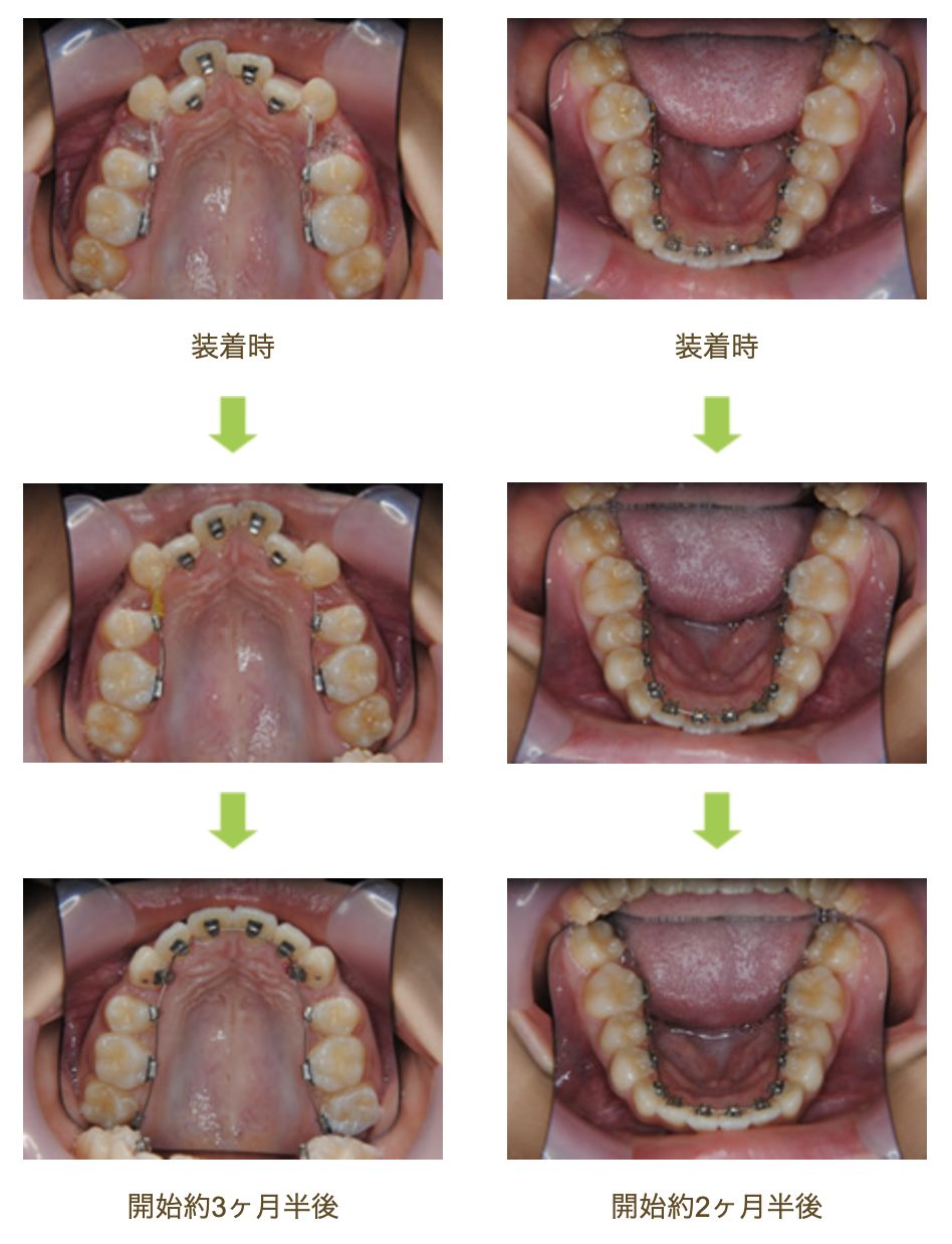 リンガルブラケット⑬　八重歯を治したい方