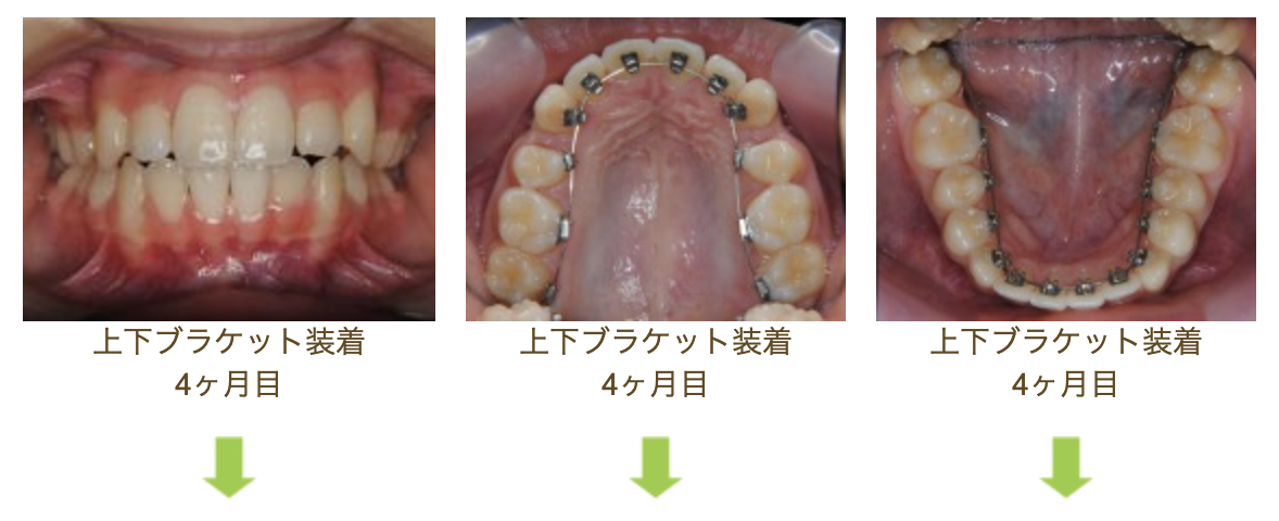 リンガルブラケット⑬　八重歯を治したい方