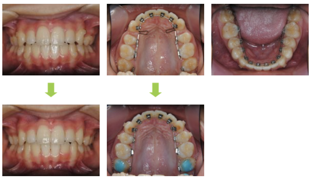 リンガルブラケット⑬　八重歯を治したい方