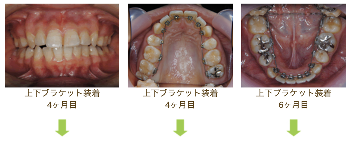 リンガルブラケット⑫　八重歯を治したい方