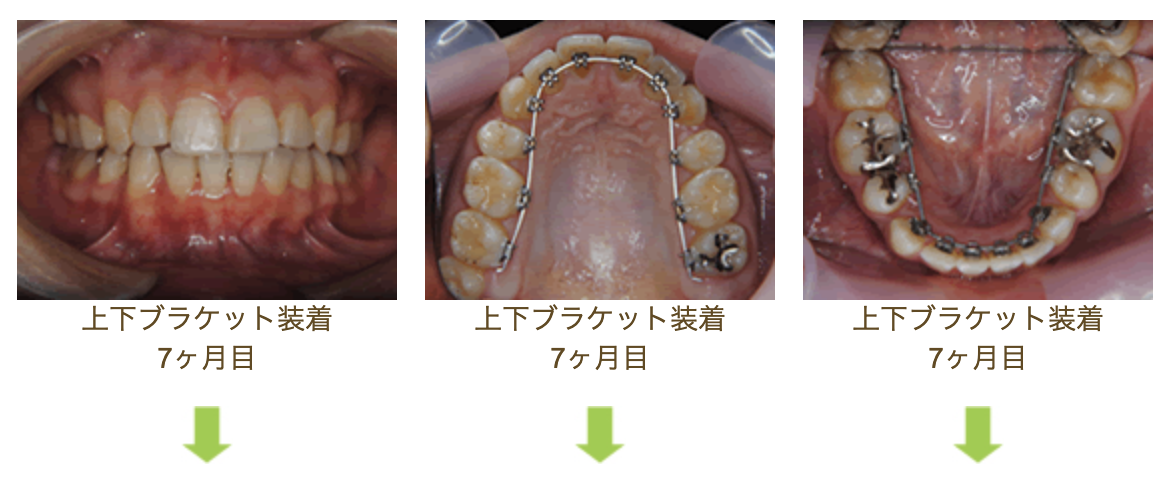 リンガルブラケット⑫　八重歯を治したい方