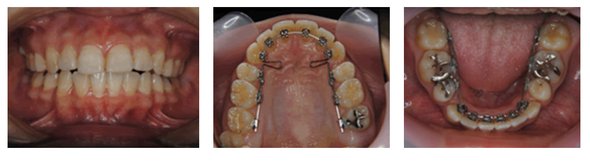 リンガルブラケット⑫　八重歯を治したい方