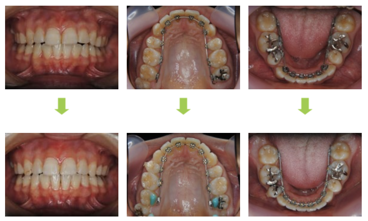 リンガルブラケット⑫　八重歯を治したい方