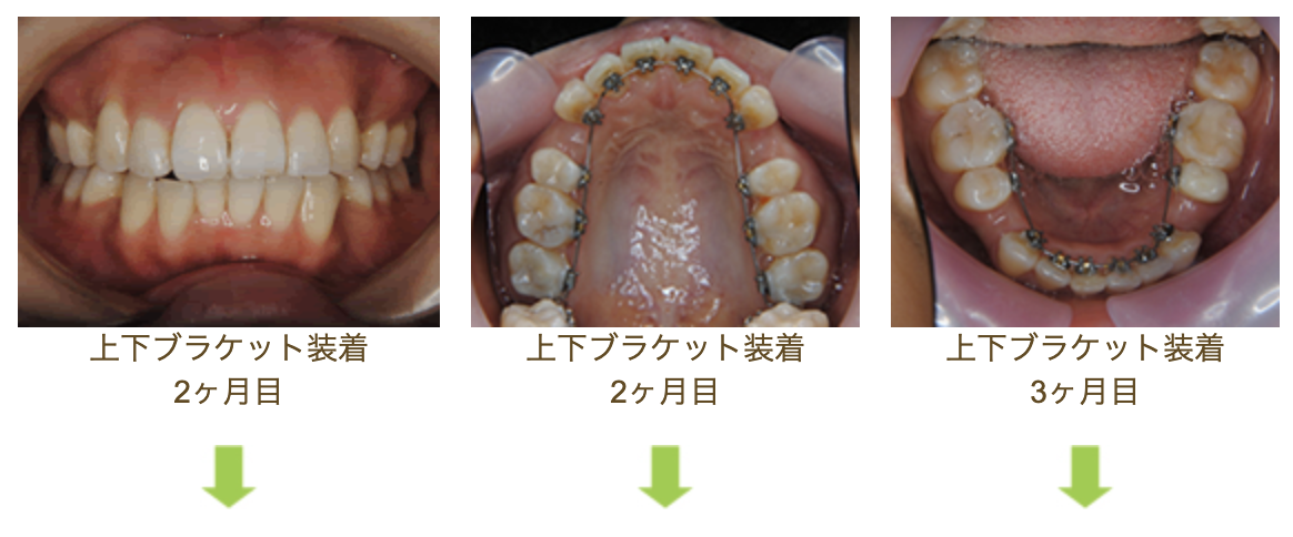 リンガルブラケット⑪　口元を引っ込めたい方