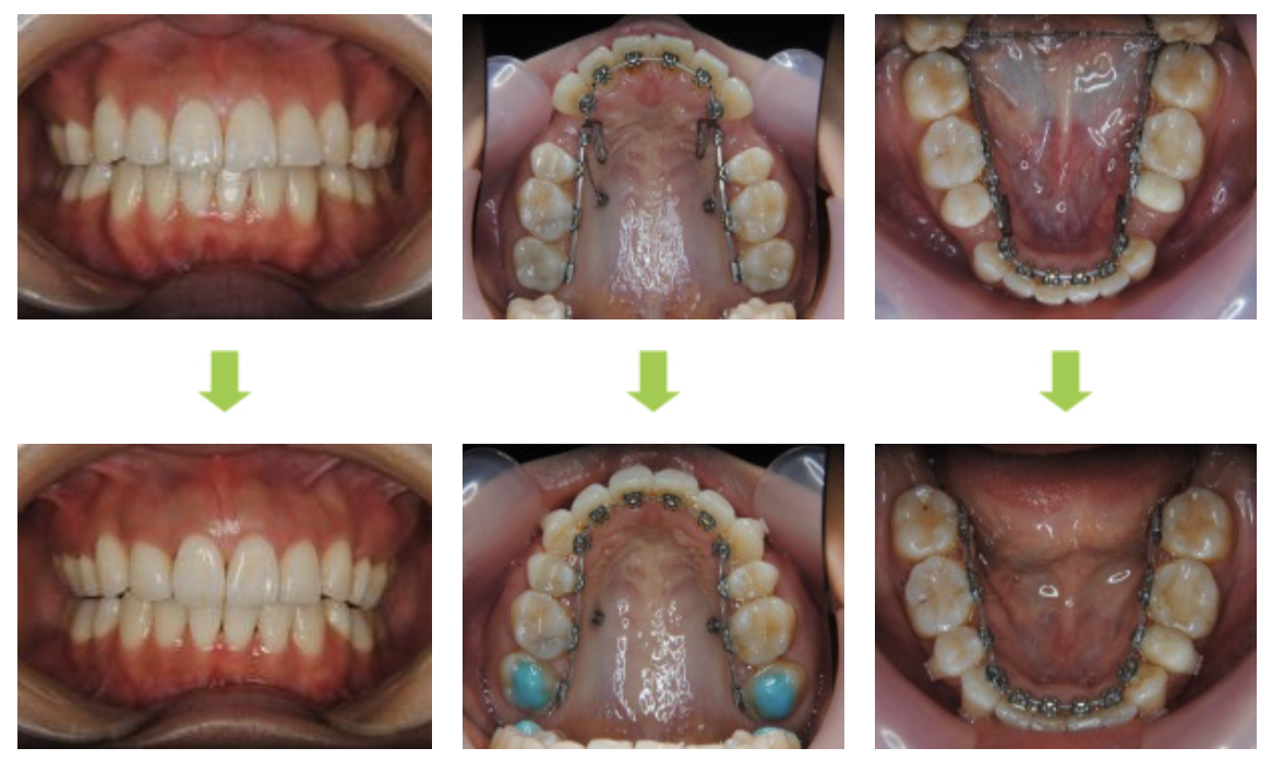 リンガルブラケット⑪　口元を引っ込めたい方