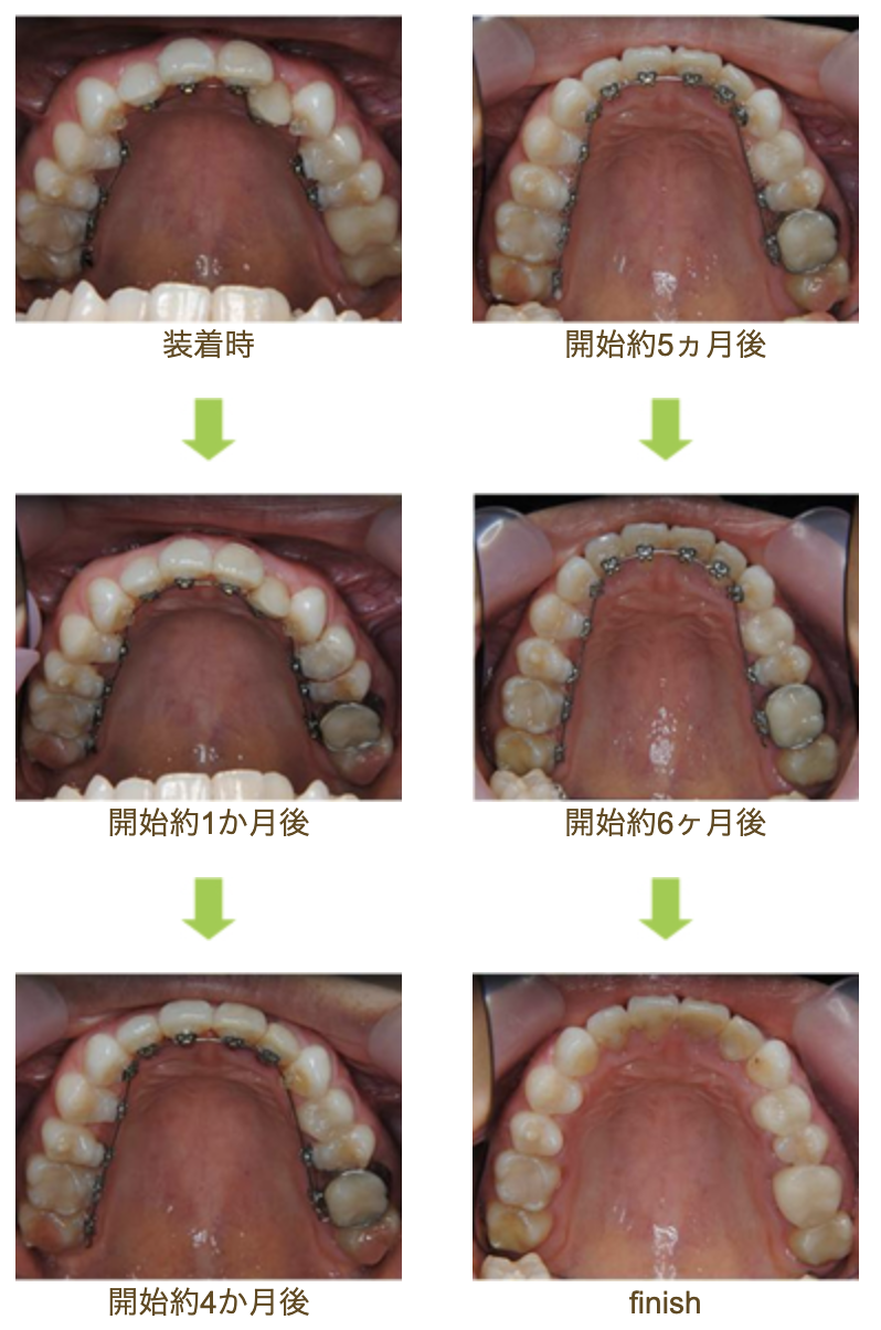 リンガルブラケット⑤　前歯1本だけ デコボコを治したい方