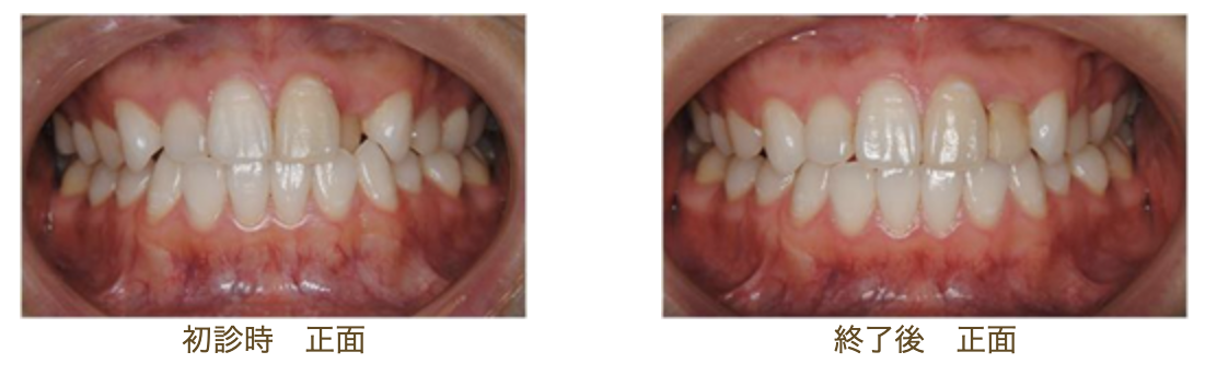 リンガルブラケット⑤　前歯1本だけ デコボコを治したい方