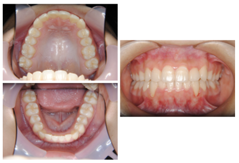 マウスピース型矯正装置（インビザライン）⑤　デコボコを治したい方